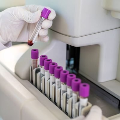 Blood test could detect Alzheimer’s signs ‘decades before symptoms appear’